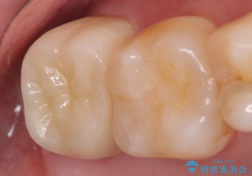 オールセラミッククラウン 他院にて抜歯と言われた歯の治療の治療後