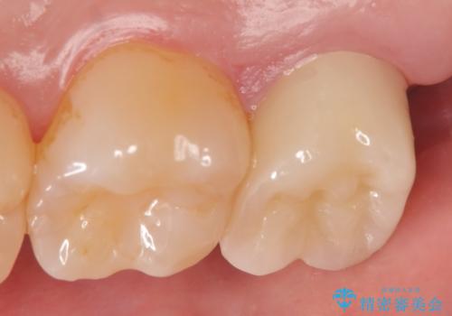 オールセラミッククラウン 他院にて抜歯と言われた歯の治療の治療後