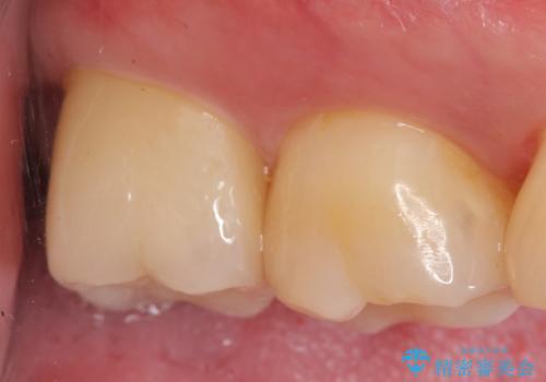 オールセラミッククラウン 他院にて抜歯と言われた歯の治療の治療後