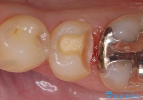 セラミックインレー　他院にて歯の神経治療が必要と言われた虫歯の治療中