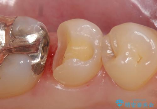 セラミックインレー 他院にて歯の神経治療が必要と言われた虫歯の治療中