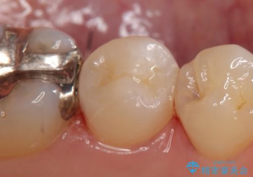 セラミックインレー 他院にて歯の神経治療が必要と言われた虫歯の治療後