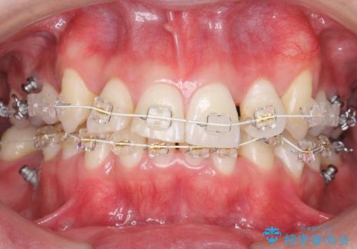 八重歯の矯正+歯のないところにインプラントの治療中