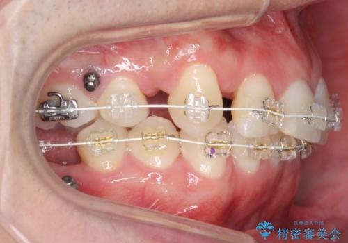 八重歯の矯正+歯のないところにインプラントの治療中