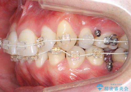 八重歯の矯正+歯のないところにインプラントの治療中