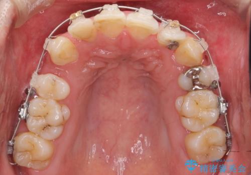 八重歯の矯正+歯のないところにインプラントの治療中