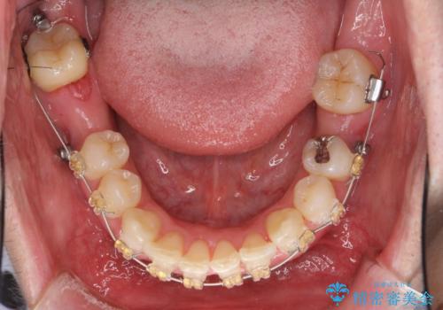 八重歯の矯正+歯のないところにインプラントの治療中
