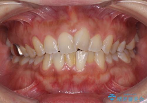 インビザラインによる狭窄歯列の拡大矯正　の症例 治療前