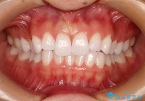 気になる前歯の歯並びをインビザラインで矯正の症例 治療前