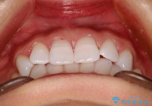 気になる前歯の歯並びをインビザラインで矯正の治療前