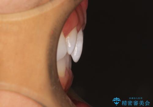 気になる前歯の歯並びをインビザラインで矯正の治療前