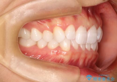 気になる前歯の歯並びをインビザラインで矯正の治療前