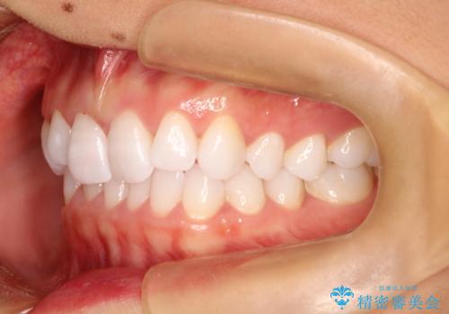 気になる前歯の歯並びをインビザラインで矯正の治療前