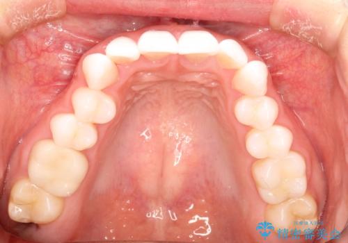 気になる前歯の歯並びをインビザラインで矯正の治療前