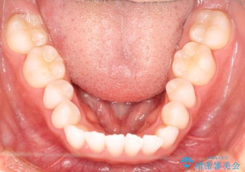 気になる前歯の歯並びをインビザラインで矯正の治療前