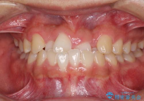 美容歯科でも断られた　著しい前歯のクロスバイトをワイヤー矯正で改善の症例 治療前