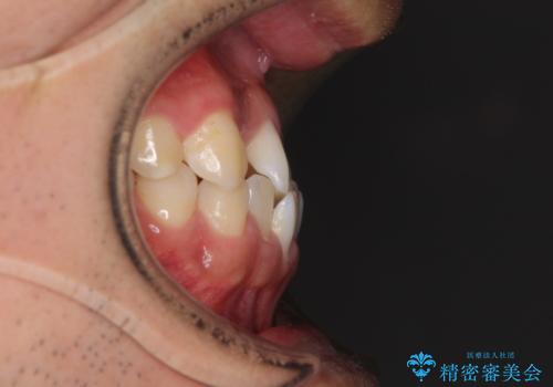 美容歯科でも断られた 著しい前歯のクロスバイトをワイヤー矯正で改善の治療前