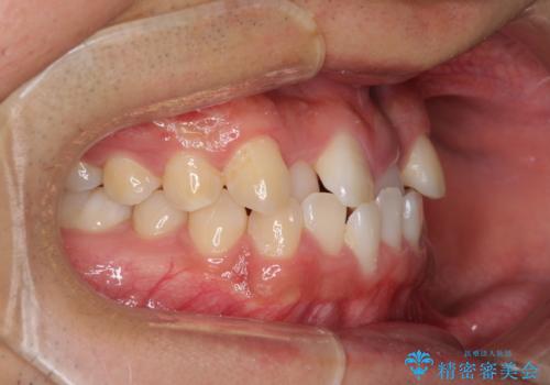 美容歯科でも断られた 著しい前歯のクロスバイトをワイヤー矯正で改善の治療前