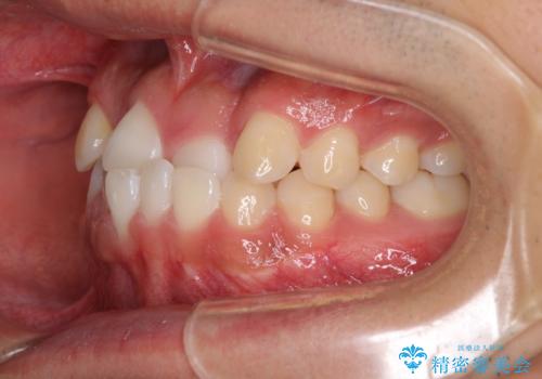 美容歯科でも断られた 著しい前歯のクロスバイトをワイヤー矯正で改善の治療前