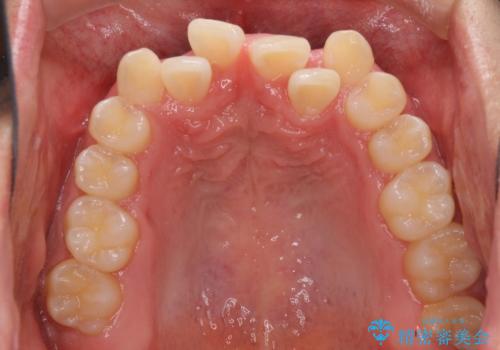 美容歯科でも断られた 著しい前歯のクロスバイトをワイヤー矯正で改善の治療前