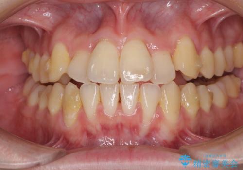 前歯のクロスバイト インビザラインによる矯正治療の治療中