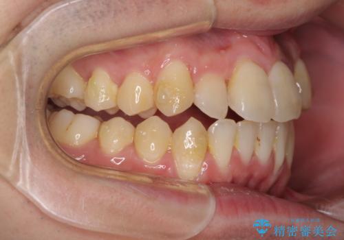 前歯のクロスバイト インビザラインによる矯正治療の治療中