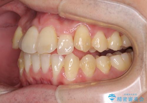 前歯のクロスバイト インビザラインによる矯正治療の治療中