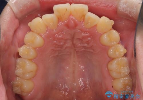 前歯のクロスバイト インビザラインによる矯正治療の治療中