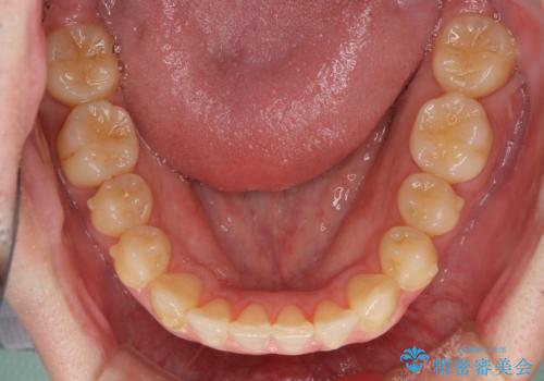 前歯のクロスバイト インビザラインによる矯正治療の治療中