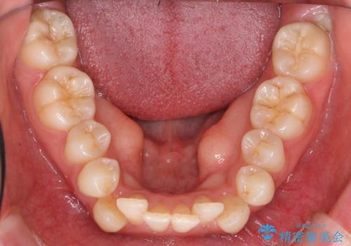 20代女性　口元を下げたい　前歯のがたつきの治療前