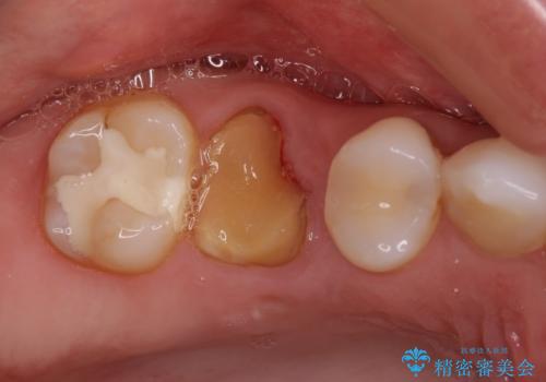 抜歯になった虫歯　奥歯のインプラント治療の治療前
