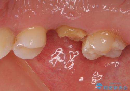 抜歯になった虫歯 奥歯のインプラント治療の治療前