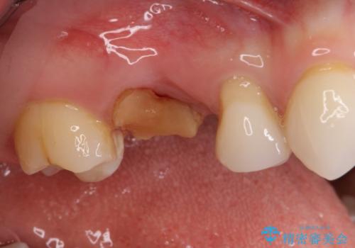 抜歯になった虫歯 奥歯のインプラント治療の治療前