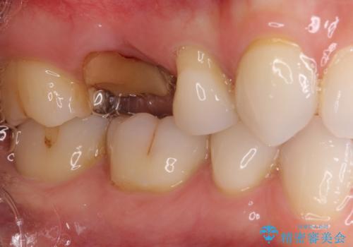 抜歯になった虫歯 奥歯のインプラント治療の治療前