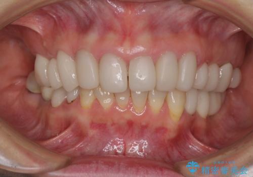 歯の欠損を放置 オールセラミックブリッジによる補綴治療の治療後