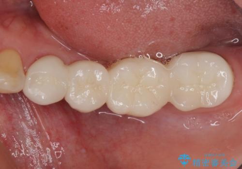 歯の欠損を放置 オールセラミックブリッジによる補綴治療の治療後