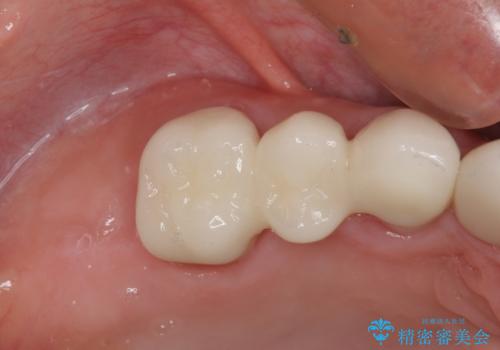 歯の欠損を放置 オールセラミックブリッジによる補綴治療の治療後