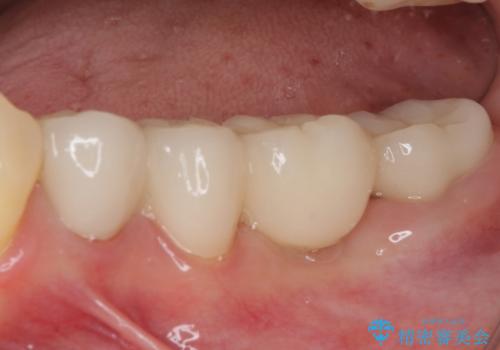 歯の欠損を放置 オールセラミックブリッジによる補綴治療の治療後