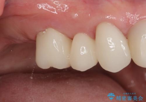 歯の欠損を放置 オールセラミックブリッジによる補綴治療の治療後
