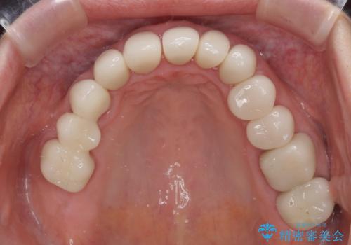 歯の欠損を放置　オールセラミックブリッジによる補綴治療の治療後