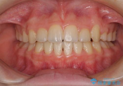 乳歯が残っている　目立たない装置での抜歯矯正の症例 治療後