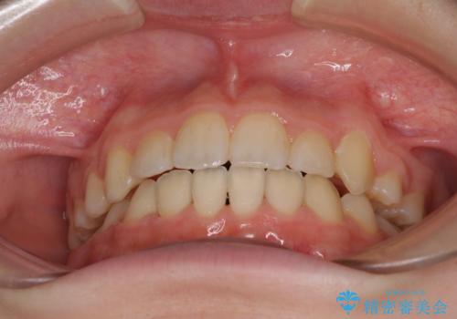 乳歯が残っている 目立たない装置での抜歯矯正の治療後