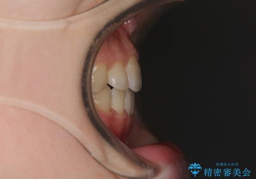 乳歯が残っている 目立たない装置での抜歯矯正の治療後