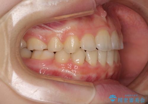 乳歯が残っている　目立たない装置での抜歯矯正の治療後