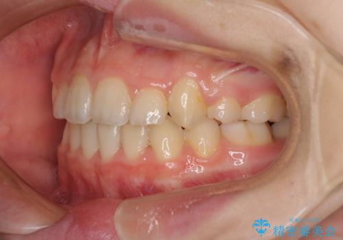 乳歯が残っている 目立たない装置での抜歯矯正の治療後