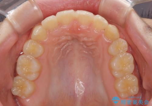 乳歯が残っている 目立たない装置での抜歯矯正の治療後
