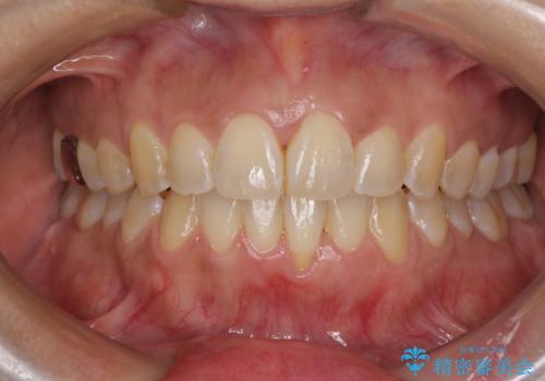 インビザラインによる狭窄歯列の拡大矯正　の症例 治療後