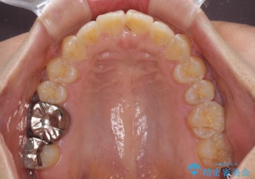 インビザラインによる狭窄歯列の拡大矯正　の治療後