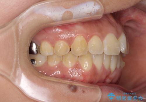 インビザラインによる狭窄歯列の拡大矯正　の治療中