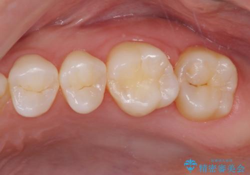 奥歯の虫歯　ゴールドインレーによる修復治療の治療前